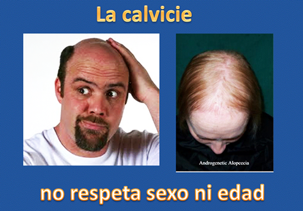 Calvicie en Guayaquil