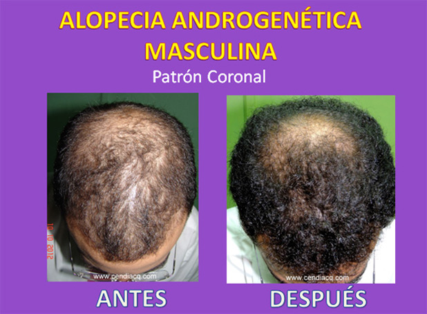 Ejemplo de Calvicie
